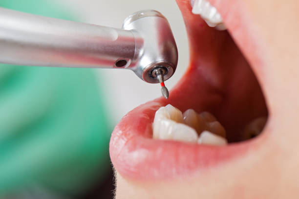 Best Emergency Dental Surgery in Pitola, CA